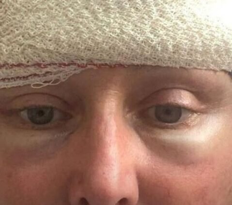 Mom found to have ten brain tumors after mistaking symptoms for menopause